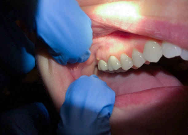 Best Dentist for Tooth Abscess  in Llano, TX
